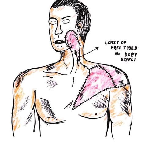 Does Pectoralis Major Myocutaneous Flap Cause the Shoulder。